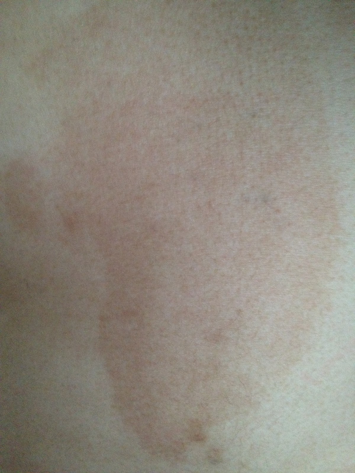 Palmer's cocoa butter. See it used on me! Do not read post if sensitive